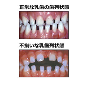 正常な乳歯・不揃いな乳歯の歯列状態・比較